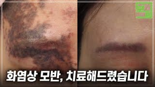 화염상 모반, 이렇게 좋아질 수 있습니다(실제 치료 사례)