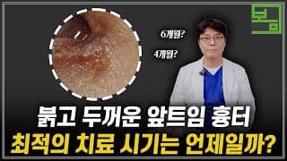 앞트임 흉터 치료? 최적의 치료 시기가 있습니다