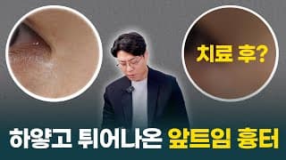 앞트임 흉터로 마음의 상처를 받으신 분들에게
