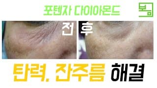 탄력, 잔주름 해결