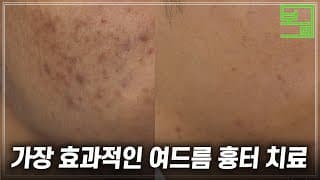 환자가 대만족한 여드름 흉터 치료사례