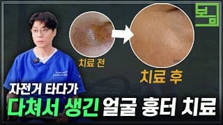 얼굴 흉터? OOO쓰면 무조건 흉터로 남습니다.(+실제 치료 사례)
